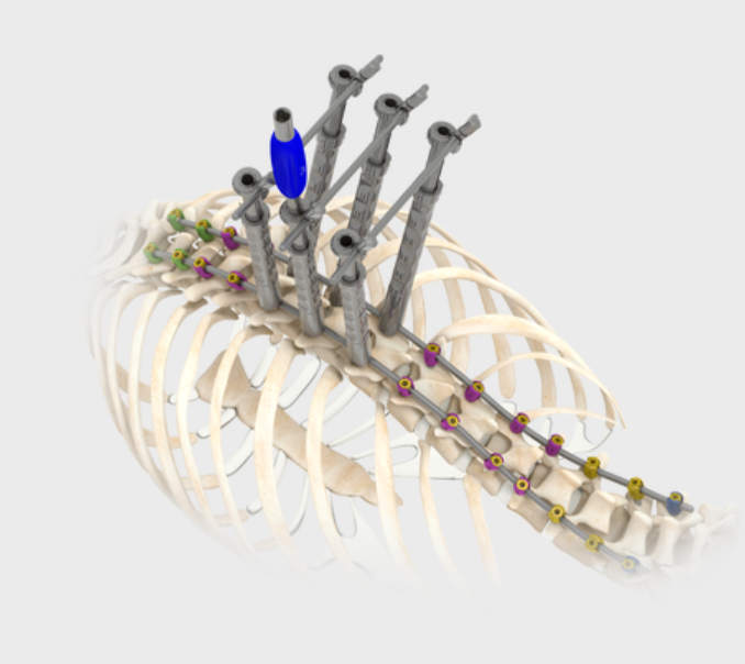 Spine System With Single Lead Thread Screws (Deformity)